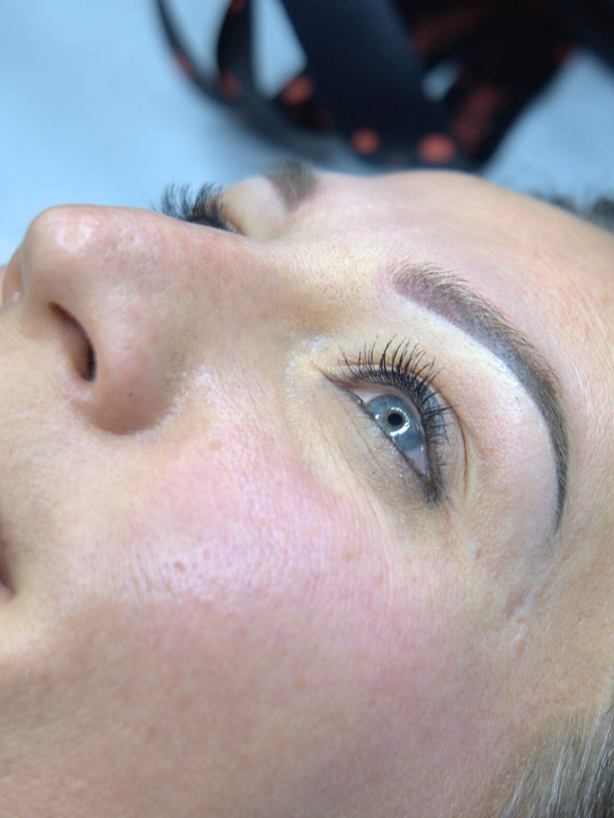 Gros plan sur le nez et la pommette d’une cliente H-Derma